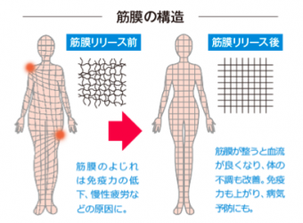 「筋膜リリース」は、2種類あるの知ってましたか？その２つの施術の違いとは・・・